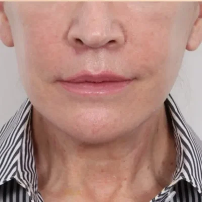 Botox-After