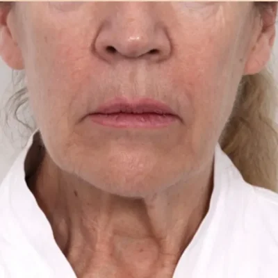 Botox-Before
